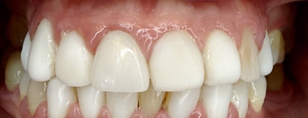 Blanqueamiento Dental Profesional — antes