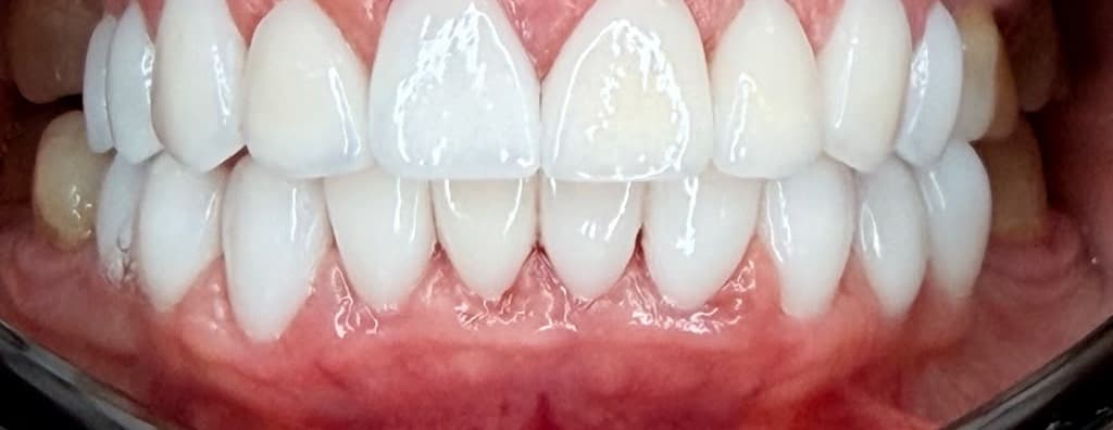 Blanqueamiento Dental Profesional — después